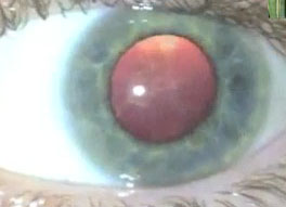 dilated pupil from eye exercise